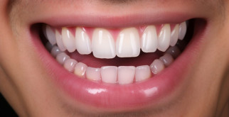 Виниры на зубы: идеальная улыбка легко и быстро