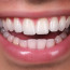 Виниры на зубы: идеальная улыбка легко и быстро