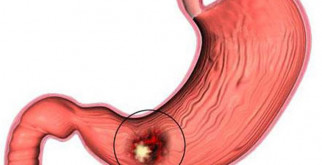 Что такое тубарная дисфункция уха и как с ней справиться