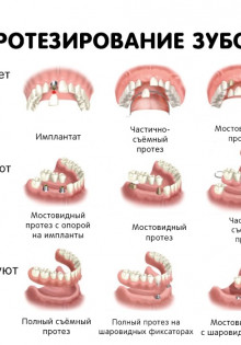 Виды протезирования зубов для пенсионеров