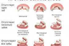 Виды протезирования зубов для пенсионеров