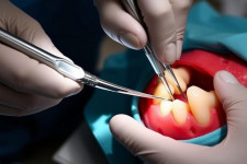 Сложное удаление зубов: что нужно знать, чтобы пройти через это без лишнего страха