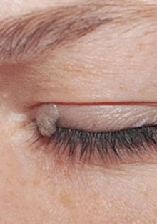 Удаление новообразования нижнего века: симптомы, причины и методы лечения