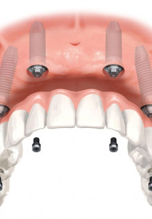 Имплантация на 4 имплантах цена в Спб