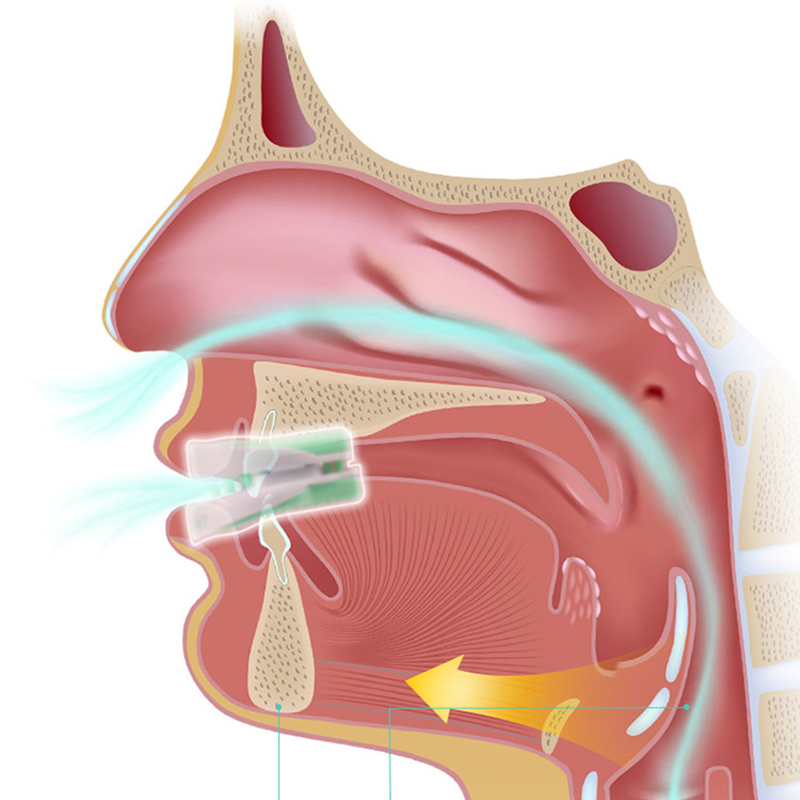 Нижняя подслизистая вазотомия. Вазотомия носовых раковин. Холодноплазменная вазотомия носовых раковин.