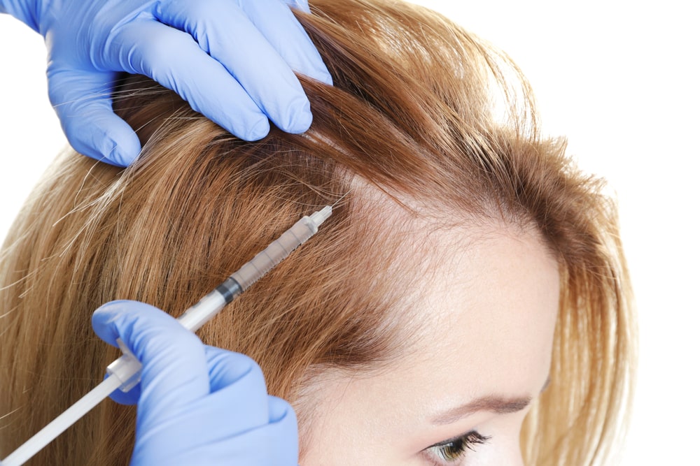 Как проводится мезотерапия волос?