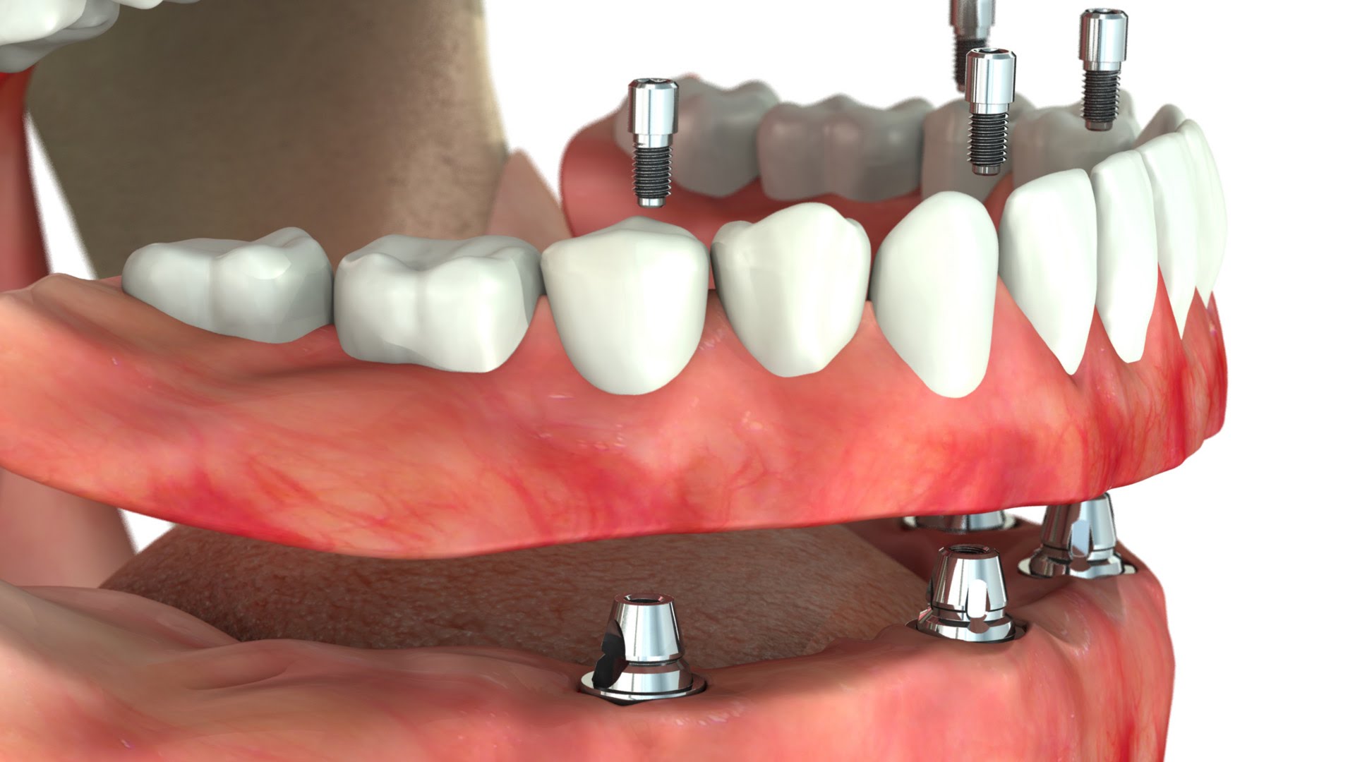 Как осуществляется протезирование зубов на имплантах?