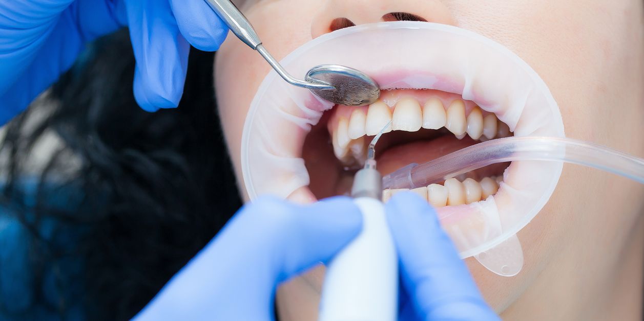 Профессиональная гигиена полости рта в стоматологии: плюсы