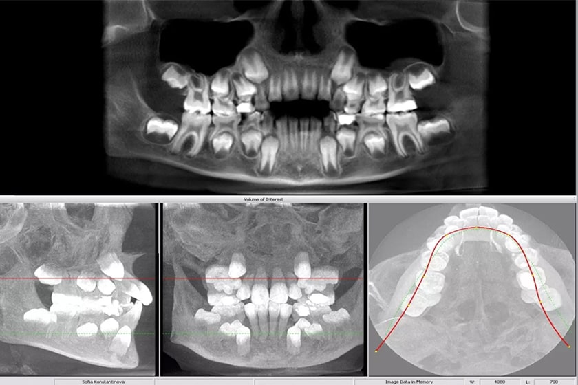 Что такое томография зубов?