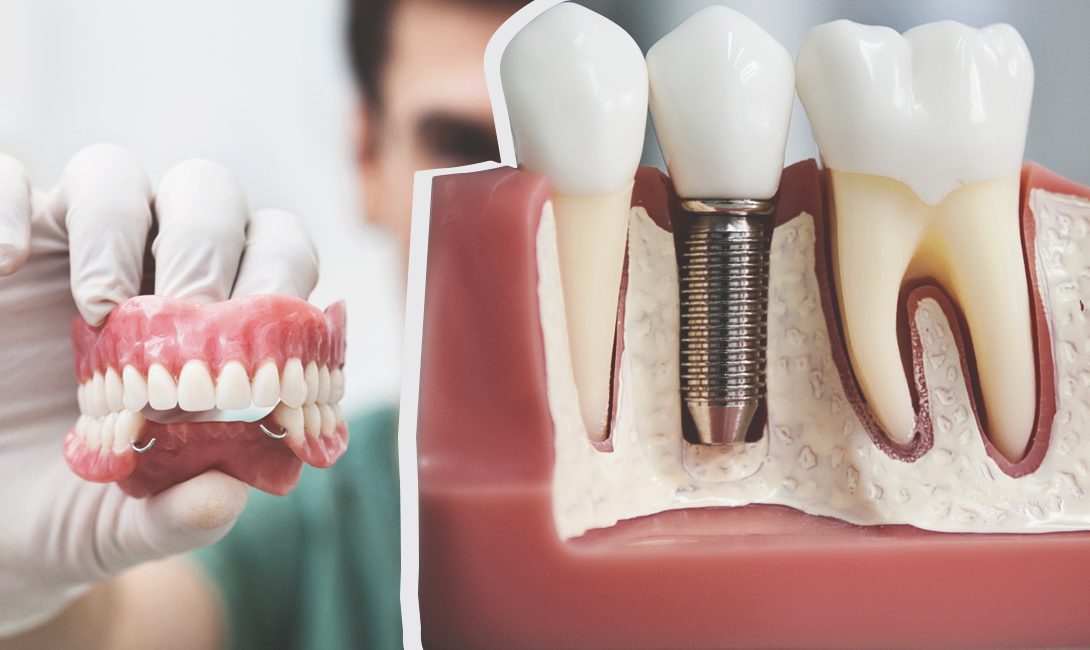 Особенности протезирования зубов в рассрочку