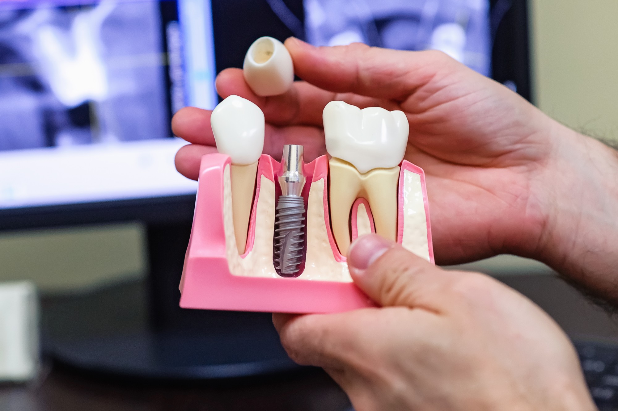 Имплантация зубов: показания, противопоказания и выполнение