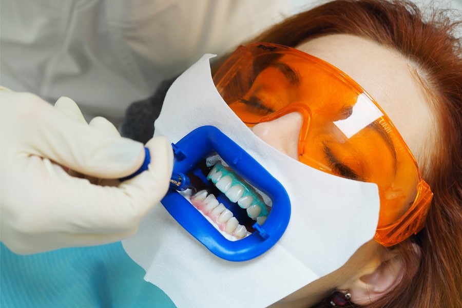 Отбеливание зубов в стоматологии: особенности услуги