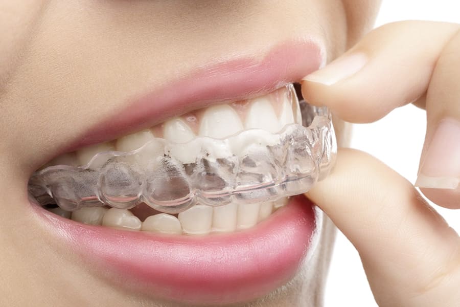 Что такое элайнеры на зубах и от чего зависит их цена?