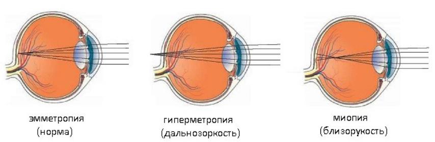 Особенности рефракции и зрения