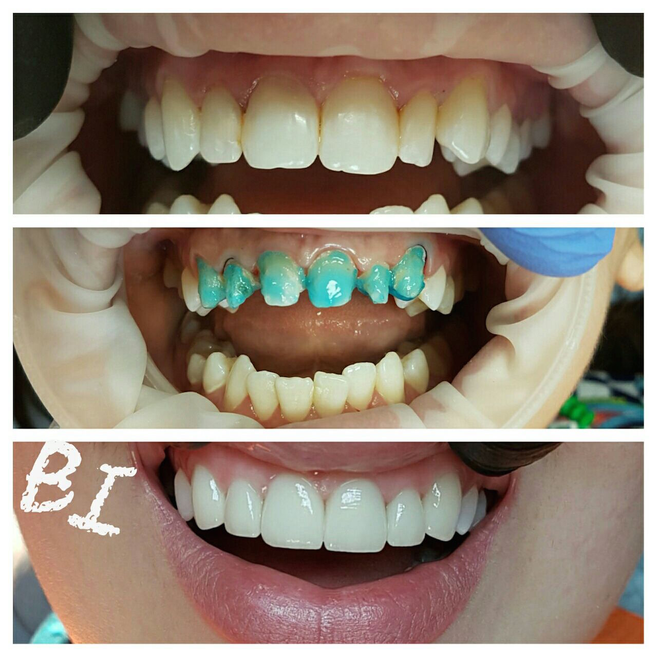 В каких случаях устанавливают виниры на зубы?