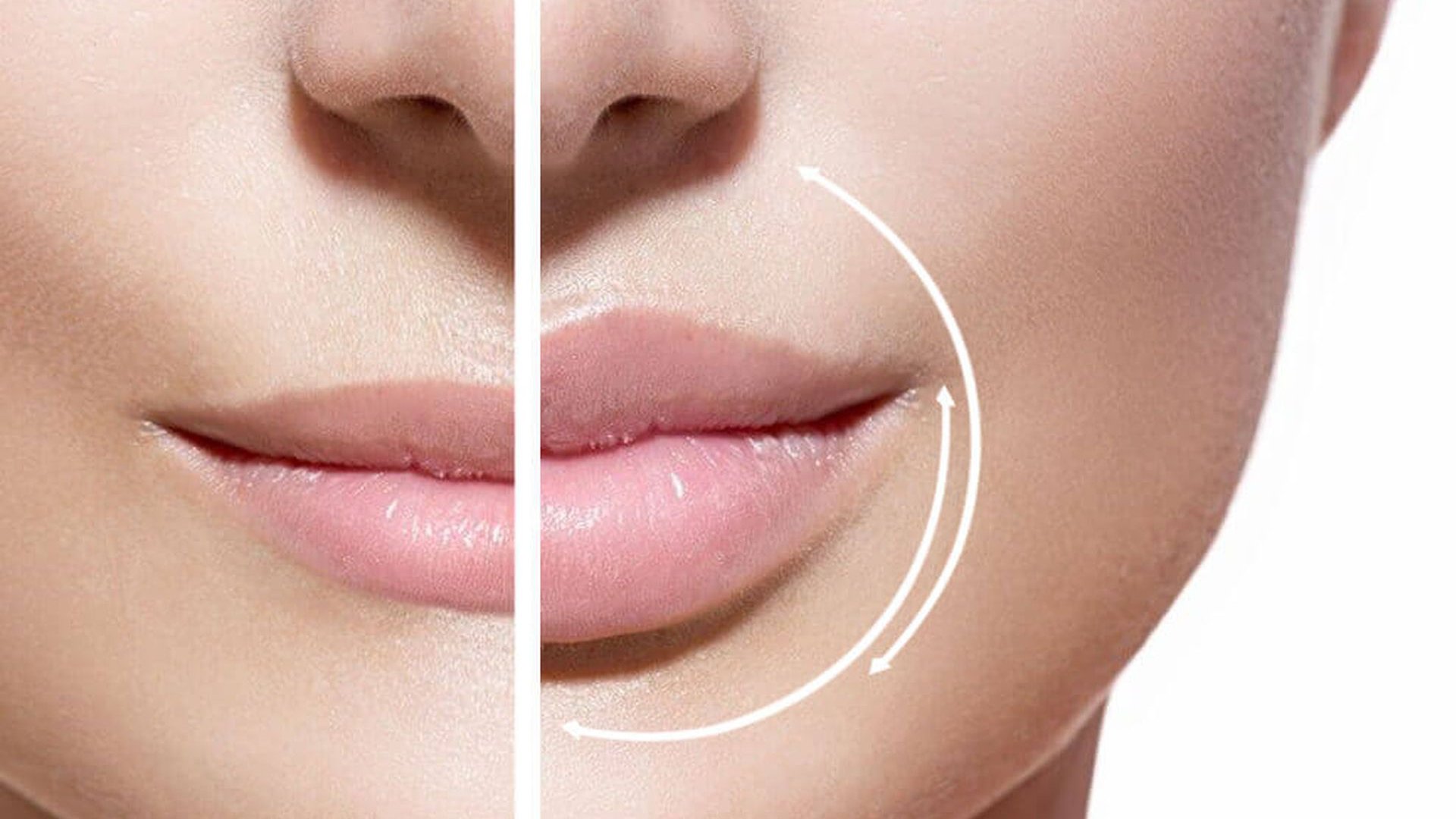 Как выполняется контурная пластика губ?