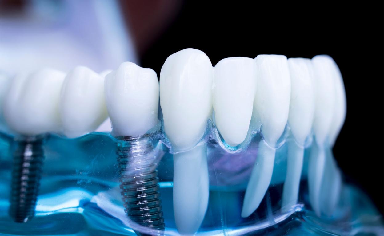 Имплантация зубов: преимущества и этапы установки
