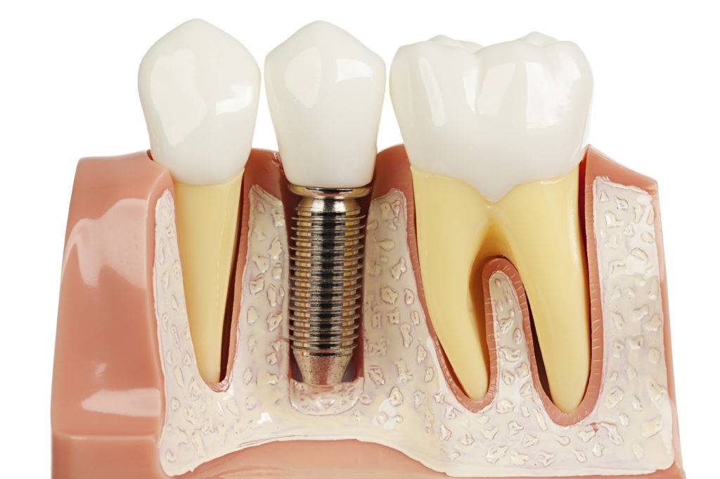 Имплантация зубов: преимущества и этапы установки