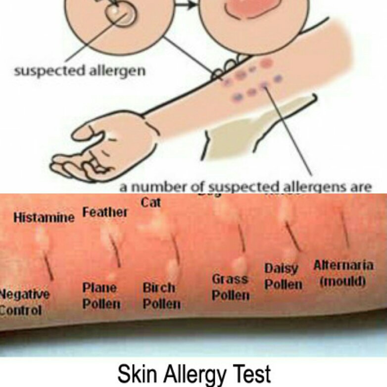 Как пройти обследование на аллергию?