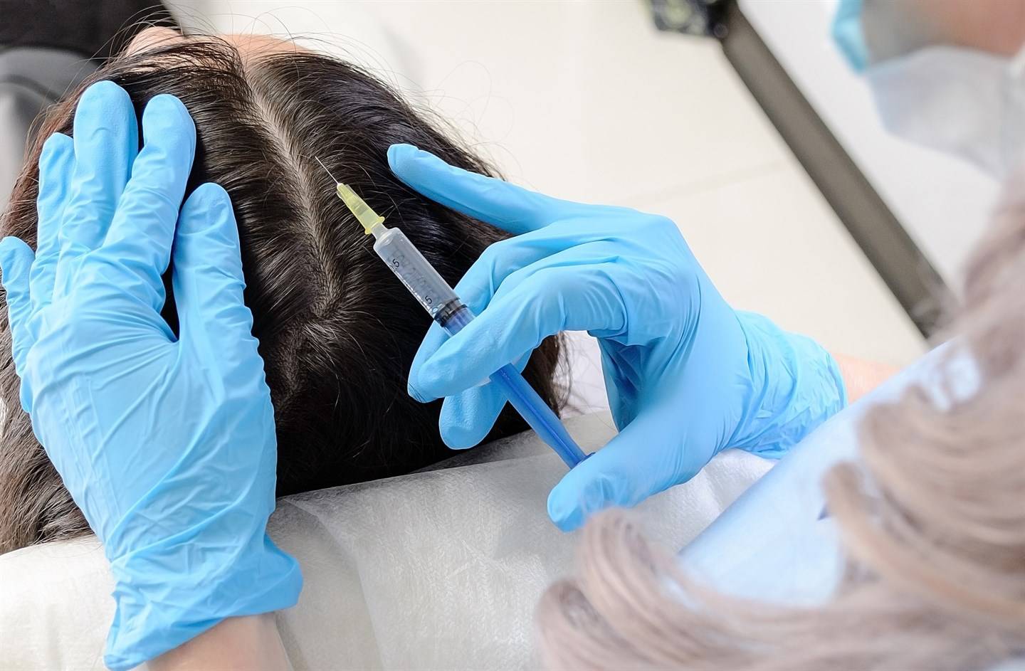 Мезотерапия волос: процесс лечения