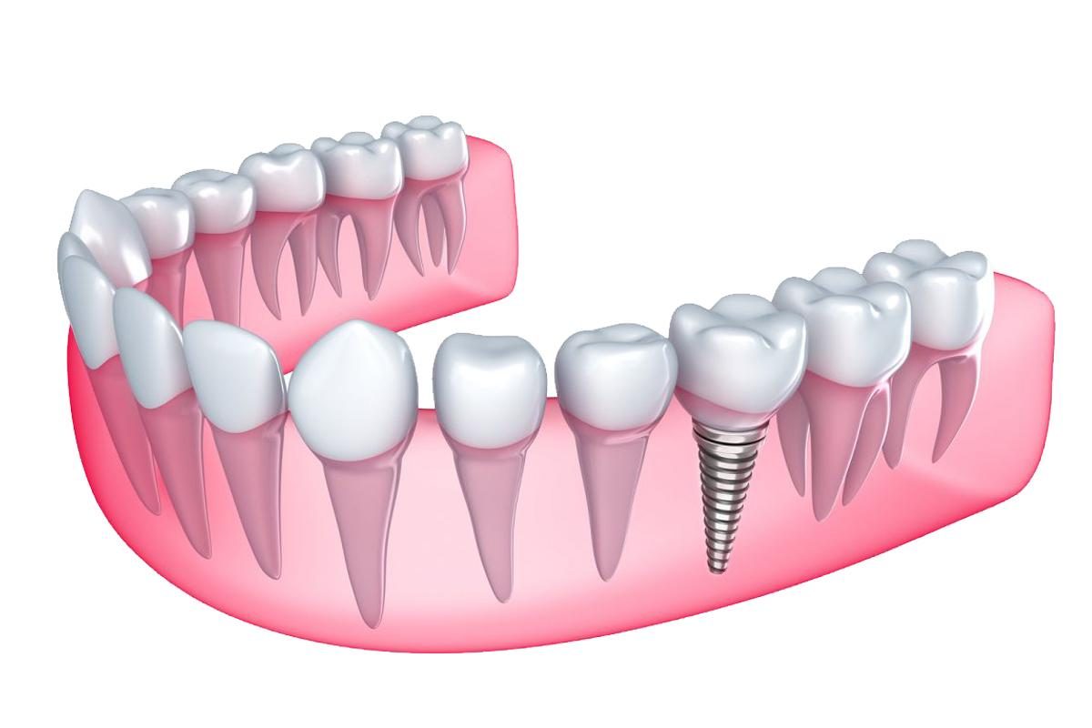 Революционные методы имплантации зубов: встречайте современные технологии!