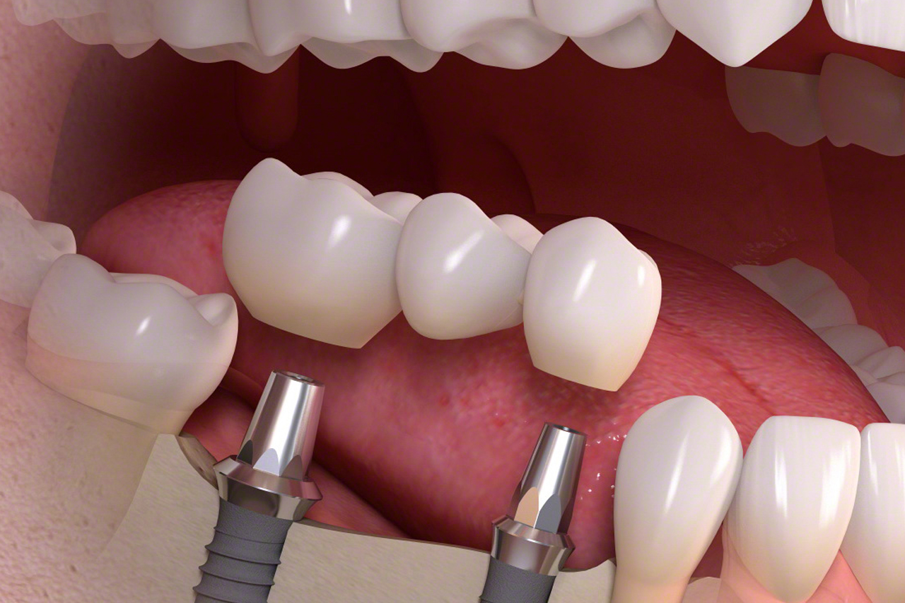 Протезирование зубов в казани
