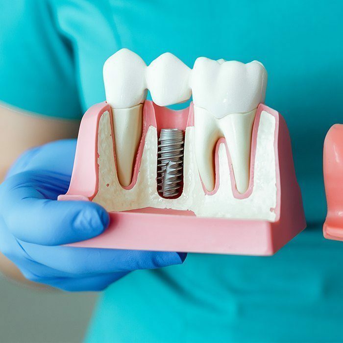 Имплантация зуба: безопасное и эффективное решение