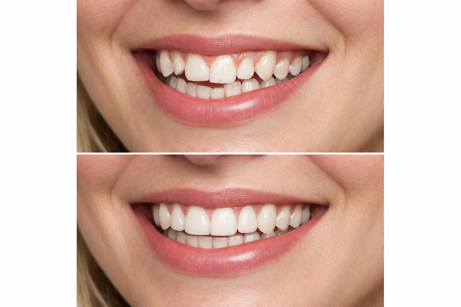 Исправление прикуса: что важно знать, чтобы не пожалеть о выборе